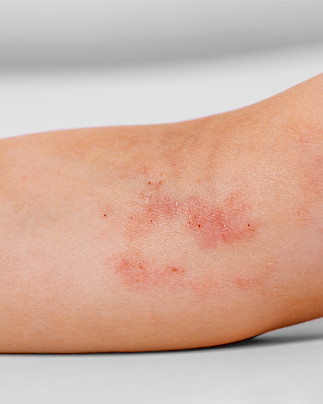elixir ancestral para curar dermatitis