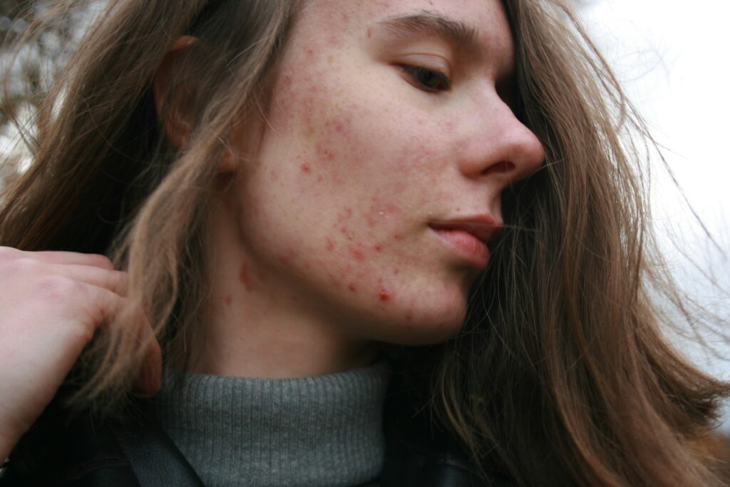a woman with a dermatitis on her face
